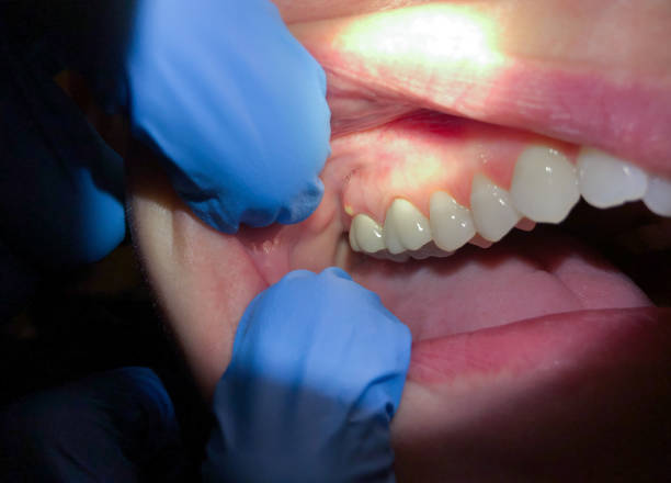 Best Knocked-Out Tooth (Avulsed Tooth) Treatment in West Liberty, IA